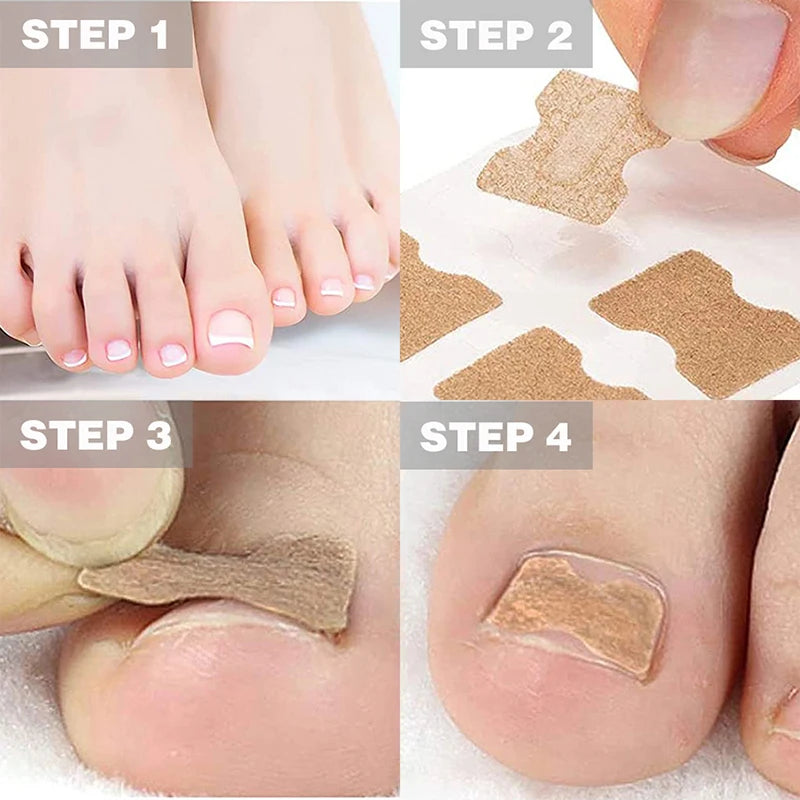 50/100Pcs Ingrown Toenail Toe Correction Stickers Nails Art Foot Patches Feet Care Paronychia Treatment Recover Pedicure Tools