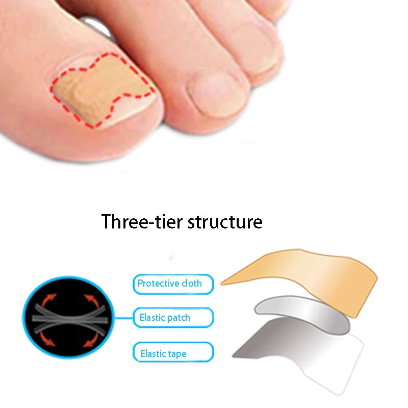 50/100Pcs Ingrown Toenail Toe Correction Stickers Nails Art Foot Patches Feet Care Paronychia Treatment Recover Pedicure Tools