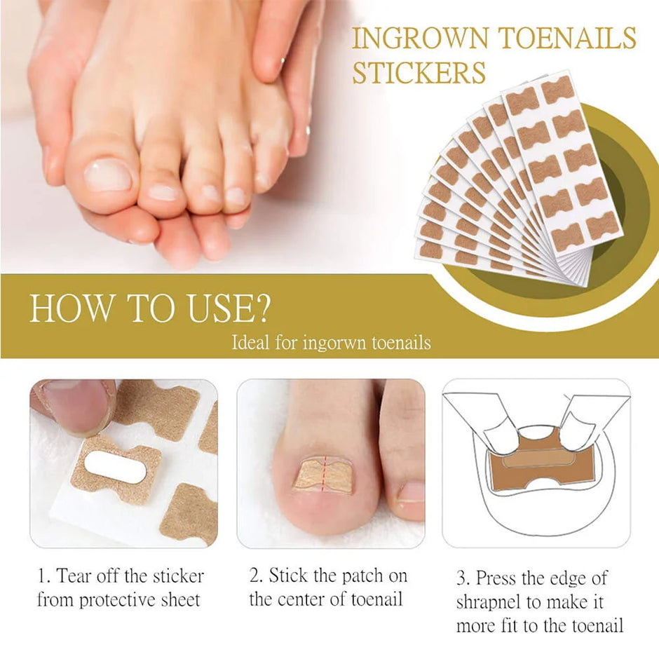 Ingrown toenail stickers with instructions on how to use them.