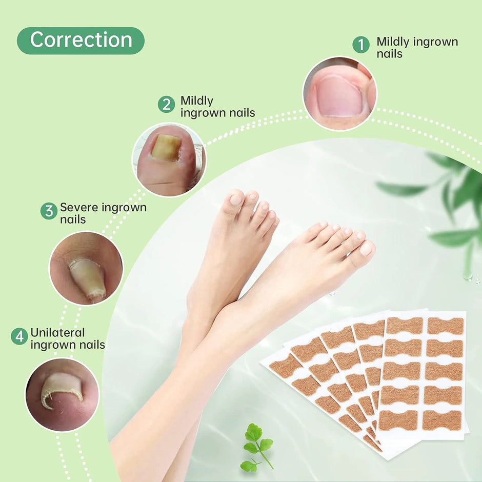 Diagram showing different types of ingrown nails and corresponding correction methods with a sheet of adhesive patches.